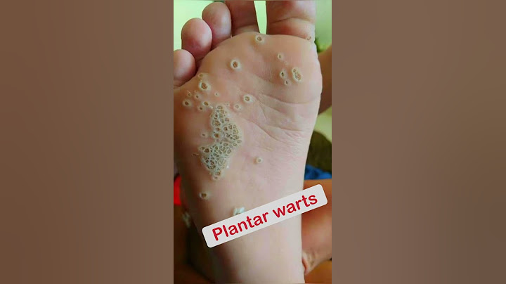 Trypophobia or plantar warts? #shorts