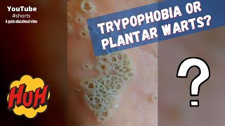 Trypophobia or plantar warts? #shorts screenshot 5
