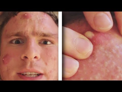 I FORCED MY PIMPLE TO POP AND WHAT HAPPENED!