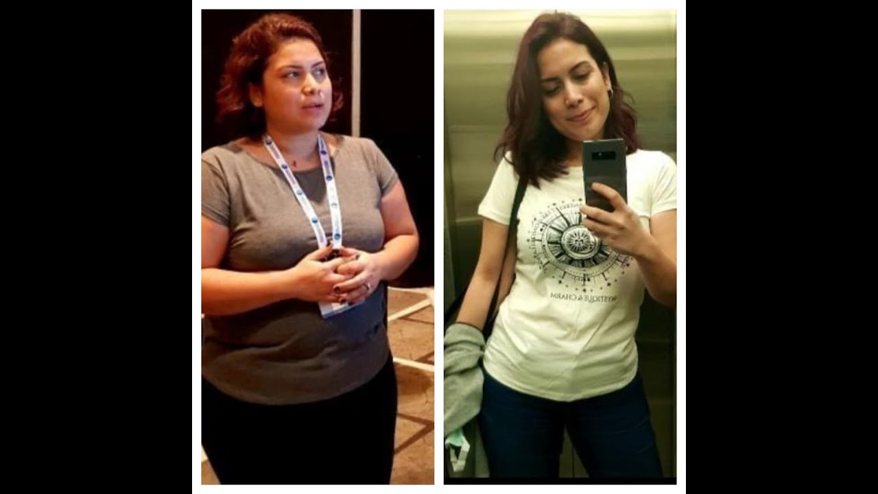 Похудение на 20 кг в Турции с помощью бариатрической хирургии