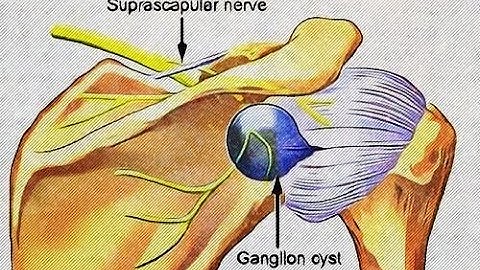 Suprascapular Neuropathy (Narrated Professionally)