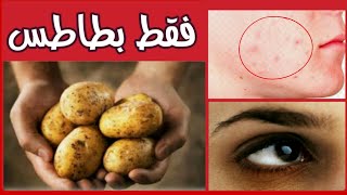 فوائد البطاطس المسلوقة | لعلاج الهالات السوداء و حب الشاب و فوائد كثيرة