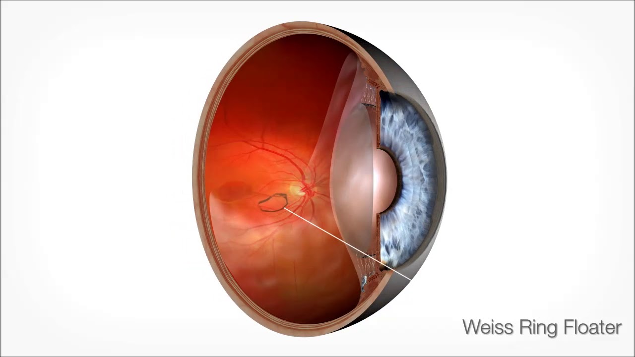 Animation Laser Vitreolysis Lotus Vision YouTube
