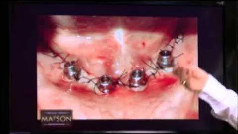 Qual é o preço de uma dentadura fixa?