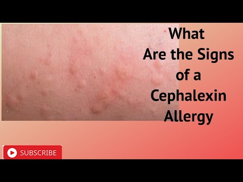 What Are the Signs of a Cephalexin Allergy