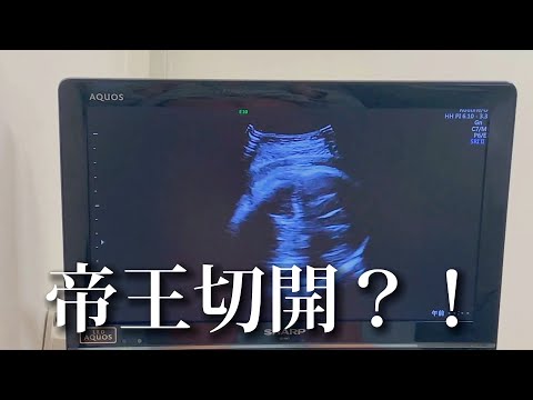 【妊娠35週】遂に…帝王切開確定か？！