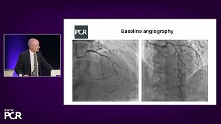 Complex PCI in high bleeding risk patients: adjust your strategy! - EuroPCR 2023 Profile