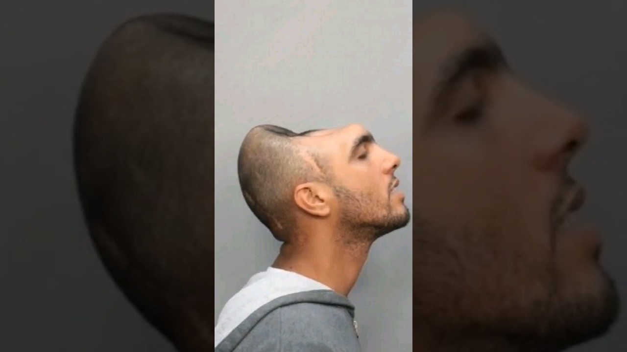 This man lost HALF his brain but miraculously survived 