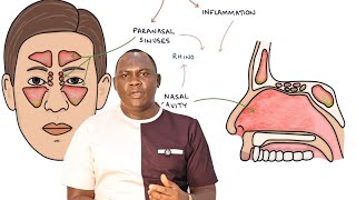 Manya ebivirako obulwadde bwe'kiwanga ( Sinusitis )