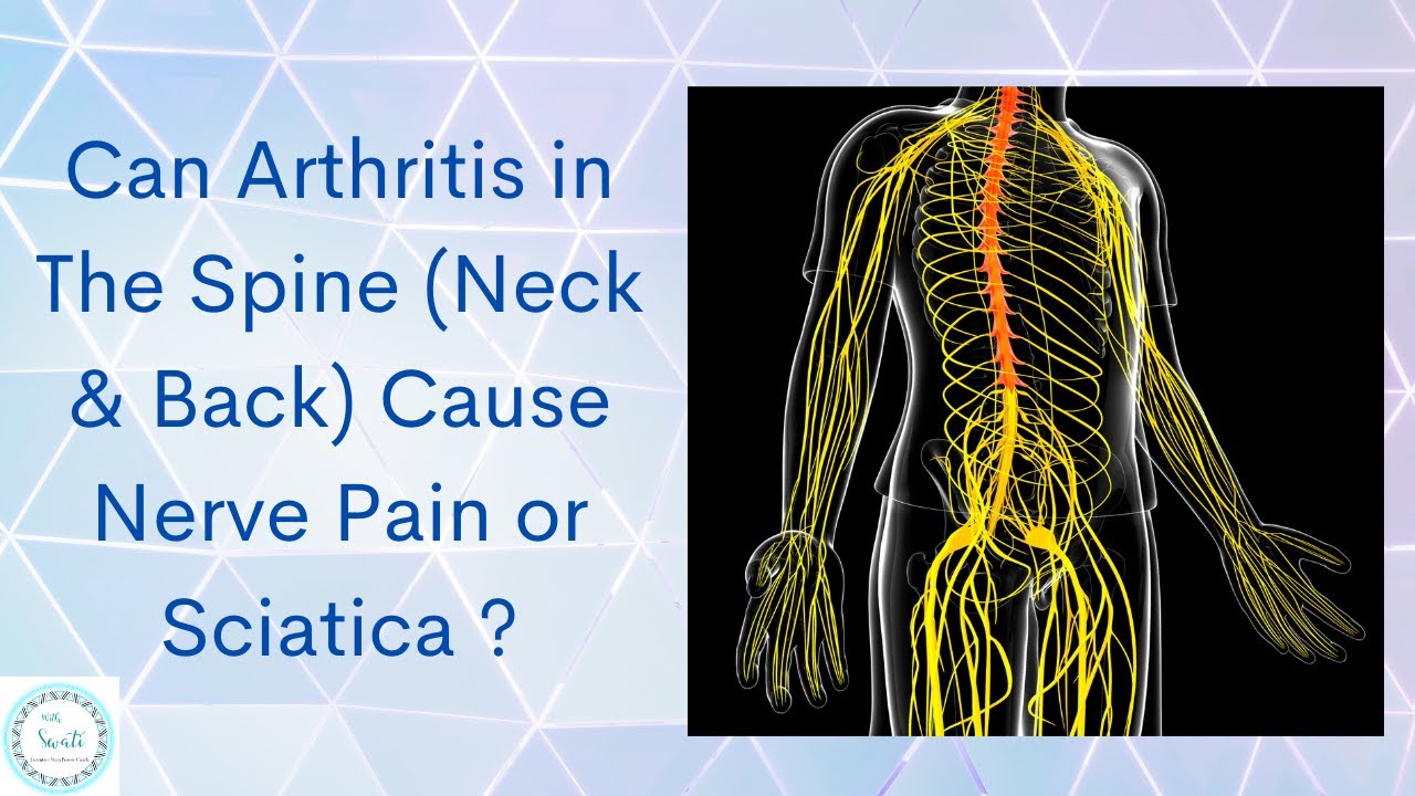 Can Arthritis in The Spine (Neck & Back) Cause Nerve Pain or Sciatica