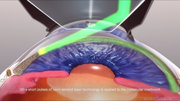 Selective Laser Trabeculoplasty (SLT) for glaucoma