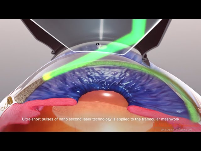 Selective Laser Trabeculoplasty (SLT) for glaucoma class=