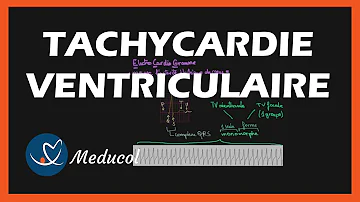 Comment soigner une tachycardie ventriculaire ?