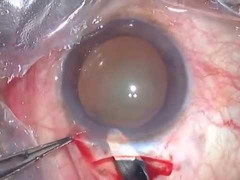 SICS in IMC Hydroexpression- Dr Prathmesh Mehta.mpg