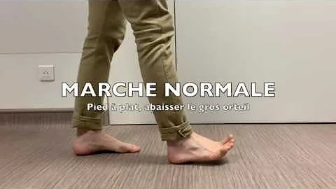 Quand marcher après fracture cheville ?