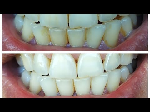 Чистка зубов в домашних условиях от налета