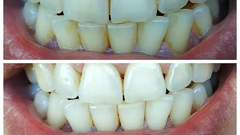 Как отбелить зубы, убрать зубной налет и зубной камень в домашних условиях. Чистка зубов без соды!