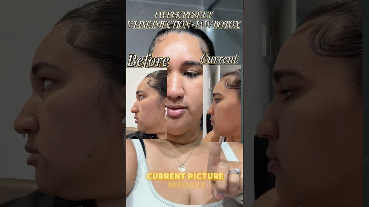 Getting a Korean V-Line Botox Injection! 💉✨ Watch the process & results! 