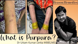 Purpura? Reason or cause of red skin/bleeding under skin/ Lal skin ka Karan| By Dr Uttam Lenka