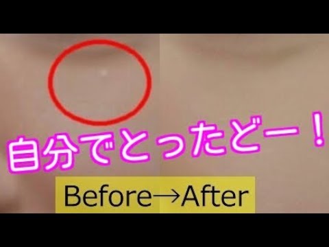 に 白い でき もの 顔 顔に脂肪の塊のようなものが発生した！取り方はどうする？