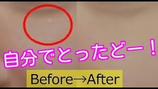 稗粒腫を自分で取る方法と本当の原因 目の周りの白いポツポツ 体験談 Youtube