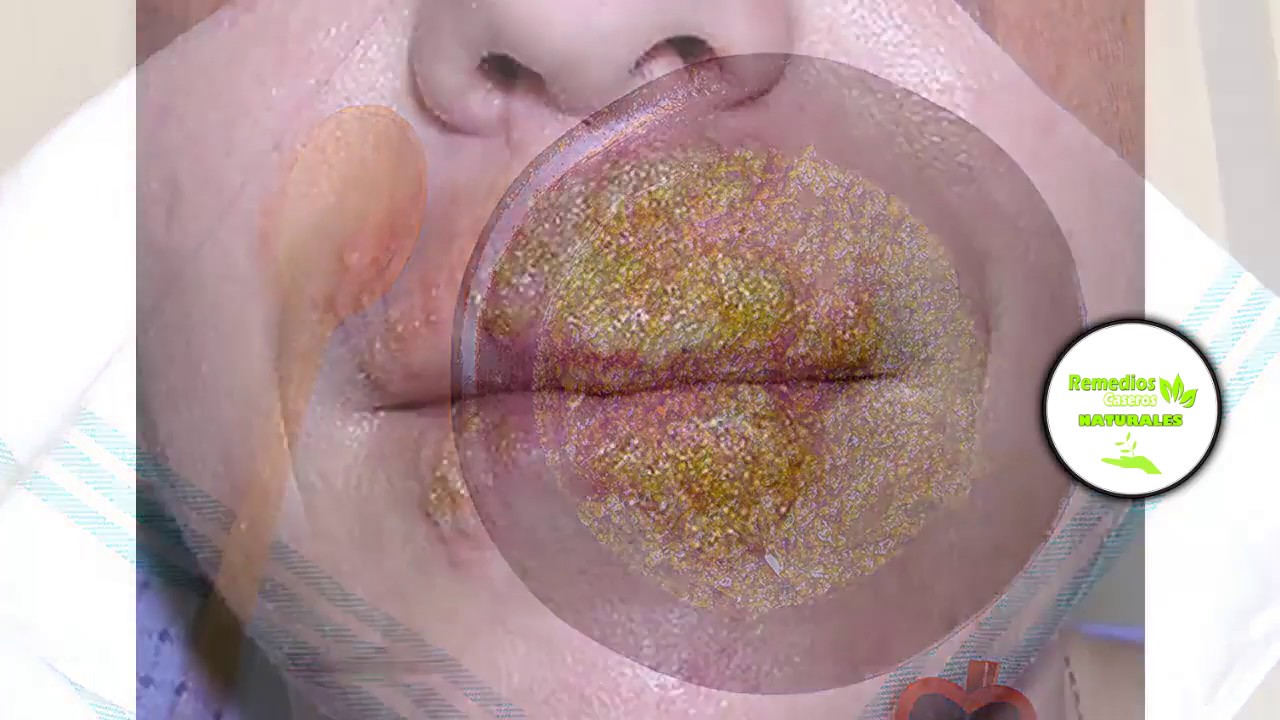 como curar ampollas en los labios remedios caseros
