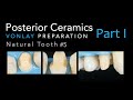 Zirconia Restoration Quadrant CERAMIC VONLAY #5 NATURAL TOOTH Part 1