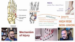 The PODdoctors: Jones Fracture