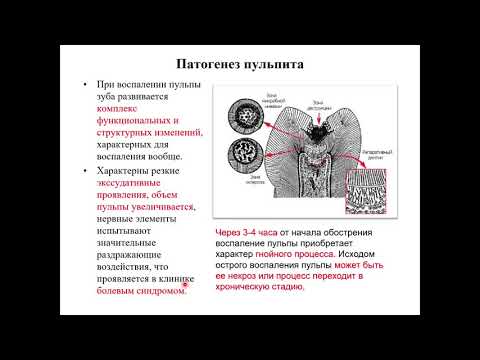 Видео: Как долго длится пульпэктомия?