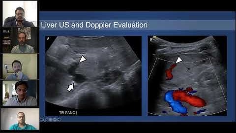 SIR-RFS Webinar Aug 15, 2020: Global Angio Club