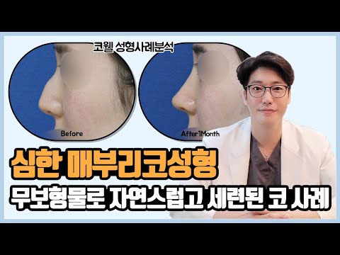 [Plastic Surgery Case Analysis] Hump Nose Correction, Natural Refined Nose Line Without Implants!