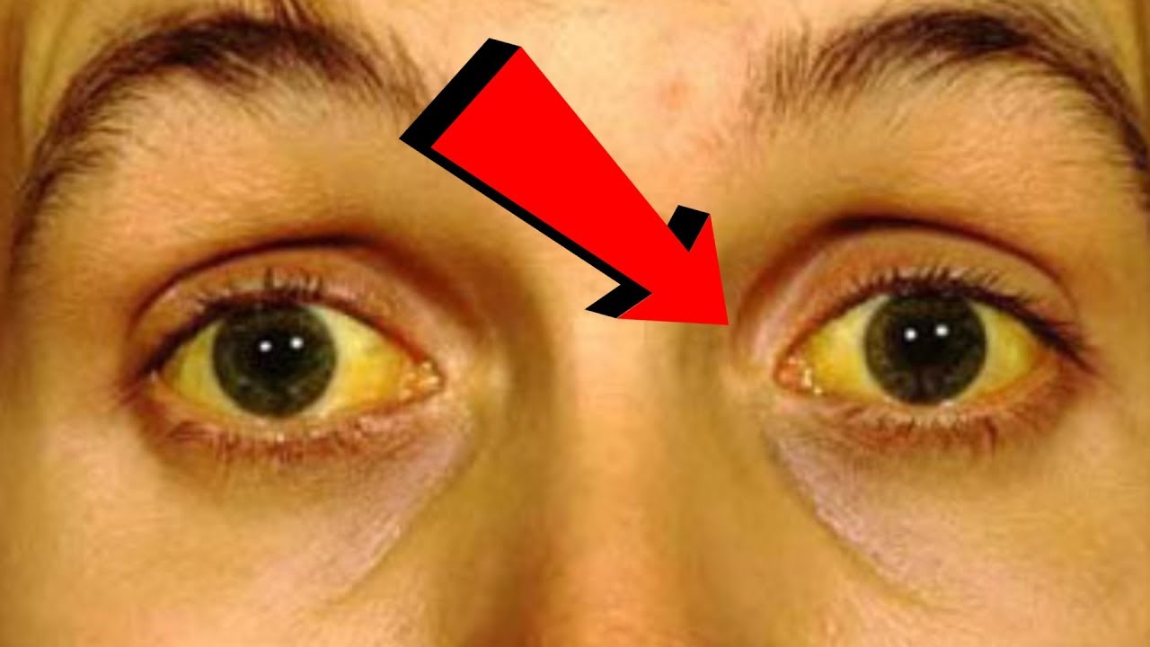 DİQQƏT! Sarılıq xəstəsi ola bilərsiniz - Əlamətləri...