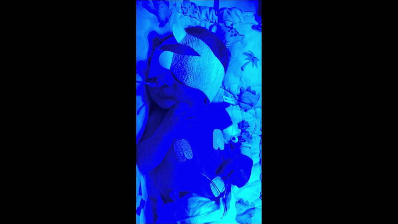 Blue light Photo therapy 4000 on neonatal department royal infirmary hospital Edinburgh