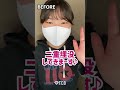 【二重整形】重たい一重まぶたが綺麗なぱっちり二重に❤ #shorts