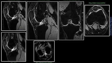 MR MSK Imaging – PDw SPACE FatSat @ Prisma 3T