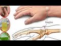 4 HOME REMEDIES FOR GANGLION CYSTS!