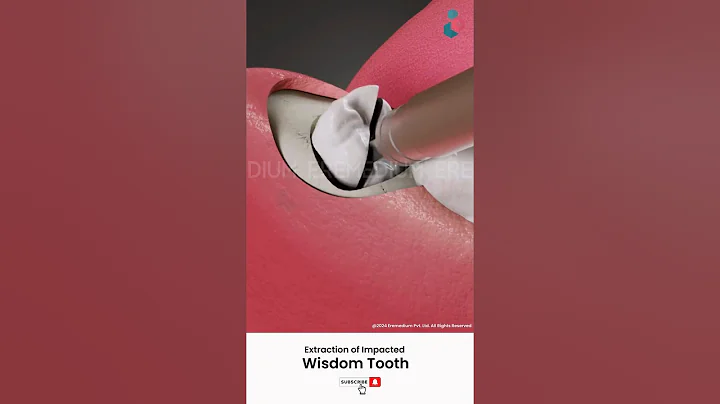 Wisdom Tooth Removal Surgery ↪ 3D Medical Animation #Shorts #WisdomTooth #Tooth #Surgery