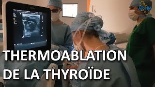 Thermoablation des nodules thyroïdiens par radiofréquence : une nouvelle technique non invasive
