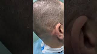 #waxing #ingrownhair #trending #maazsafder #hairremoval #asmr #hair #beard #remove #natural NK.0945.