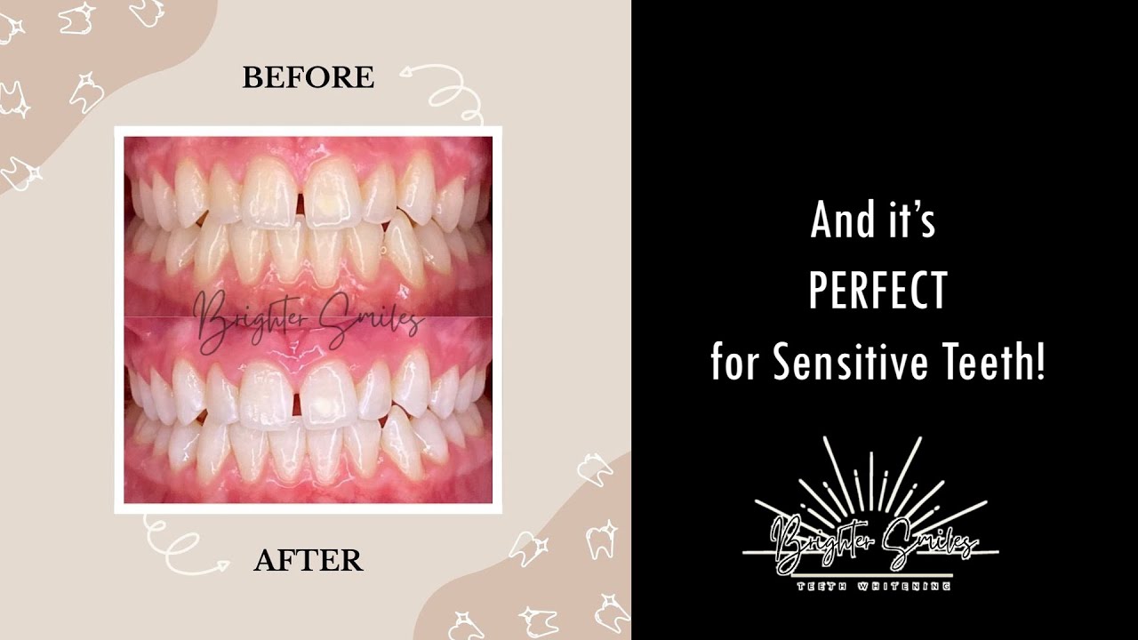 Brighter Smiles Teeth Whitening - PERFECT for Sensitive Teeth