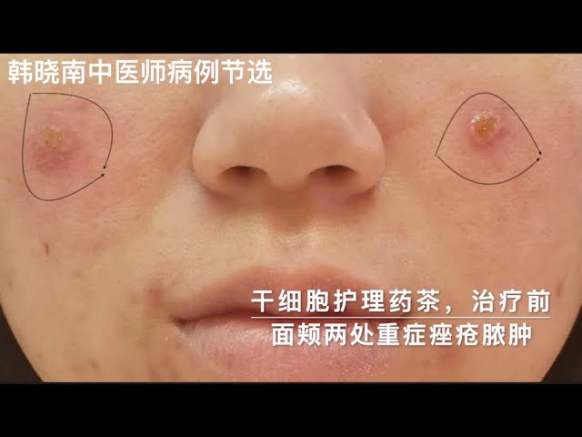 Acne / pimple treatment with natural herbal tea, Auckland, New Zealand. 