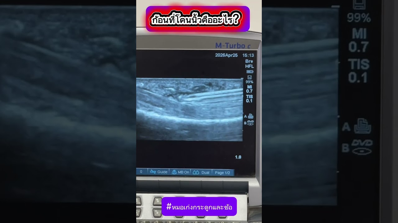 ก้อนที่โคนนิ้วคืออะไร?
