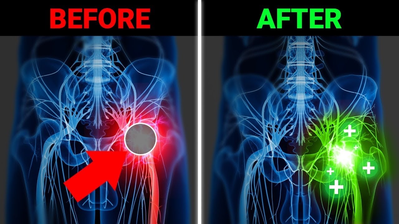 I Couldn't Fix My Sciatica Until I Did This