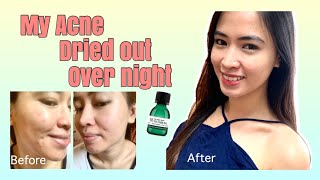 How I got rid of my cystic acne overnight!| | Tea tree oil |My honest review