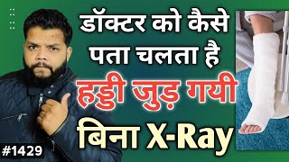 हड्डी जुड़ गयी या नही कैसे पता करें बिना X Ray | How To Check Recovery Of Broken Bone screenshot 2