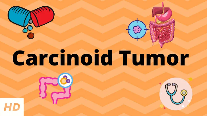 Carcinoid Tumor, Causes, Signs and Symptoms, Diagnosis and Treatment.