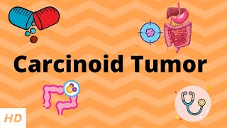 Carcinoid Tumor, Causes, Signs and Symptoms, Diagnosis and Treatment.