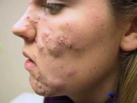 Best Way To Get Rid Of Pimples Under The Skin - YouTube