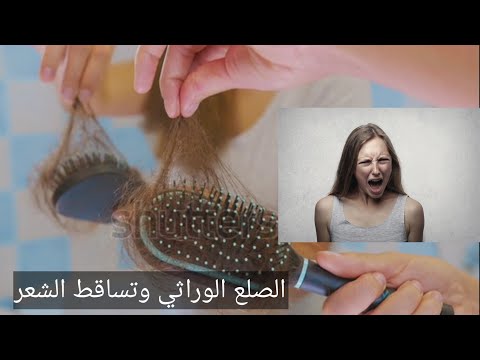الصلع