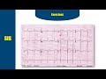 شرح تخطيط القلب ECG الحلقة السادسة QRS Complex 